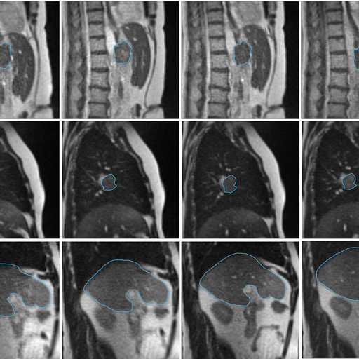 Deep learning based super-resolution for CBCT dose reduction in ...