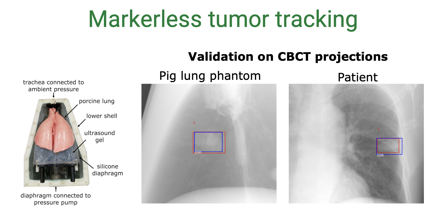 Markerless Tumor Tracking | LMU ART Lab