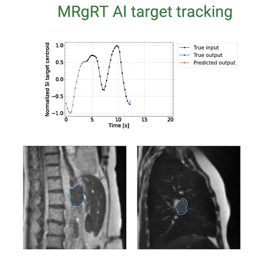 MRgRT AI-based Target Tracking