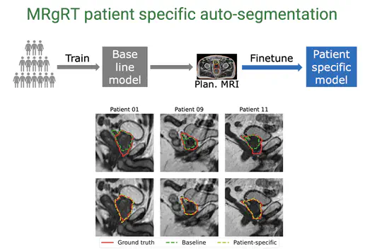 Patient Specific Auto-Segmentation for MRgRT